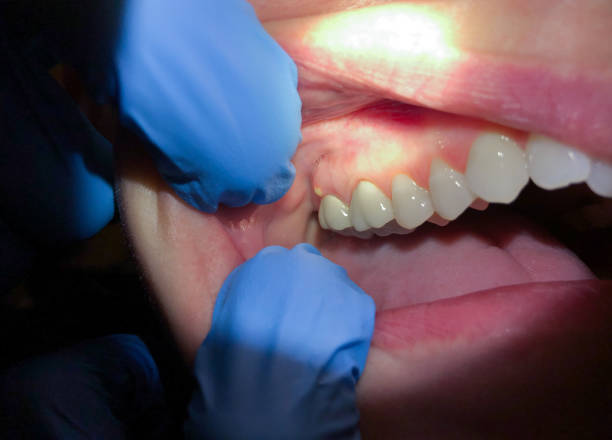 Best Broken or Cracked Tooth Emergency Dentist in USA